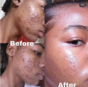 ACNE/DARK SPOT REMOVER RITUAL