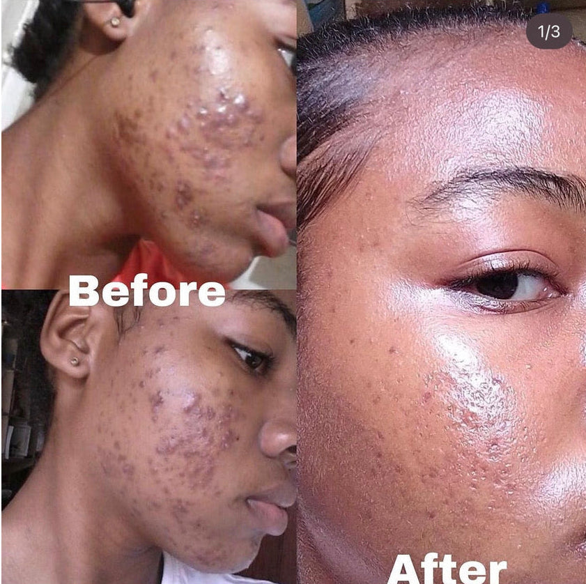 ACNE/DARK SPOT REMOVER RITUAL