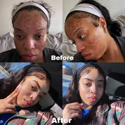 ACNE/DARK SPOT REMOVER RITUAL