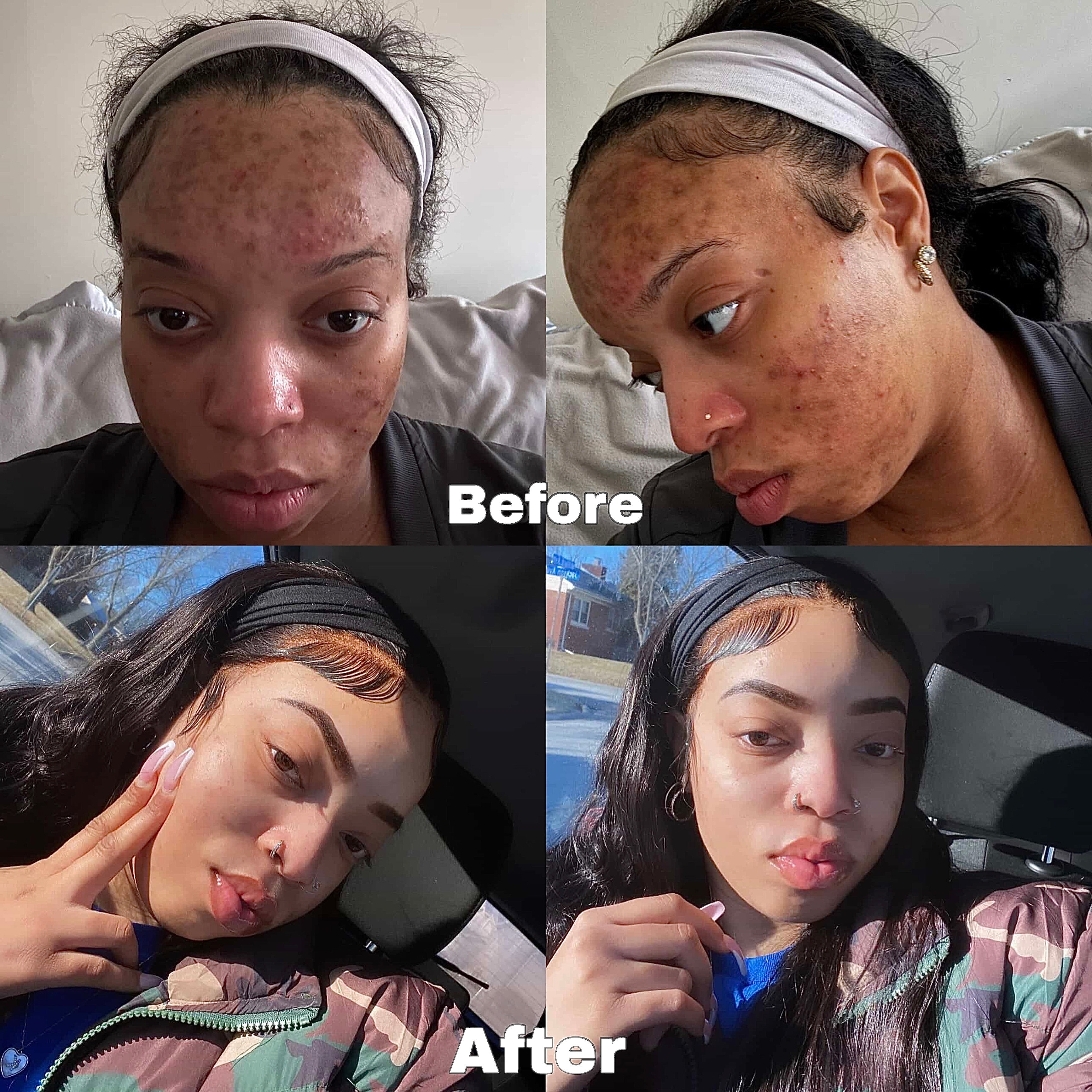 ACNE/DARK SPOT REMOVER RITUAL